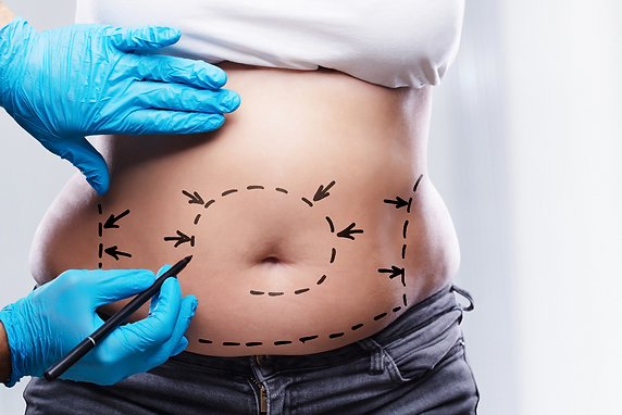 plastic surgery - weight loss